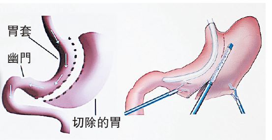 手术示意图