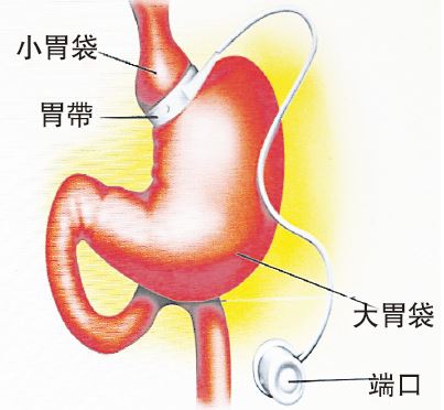 手术示意图