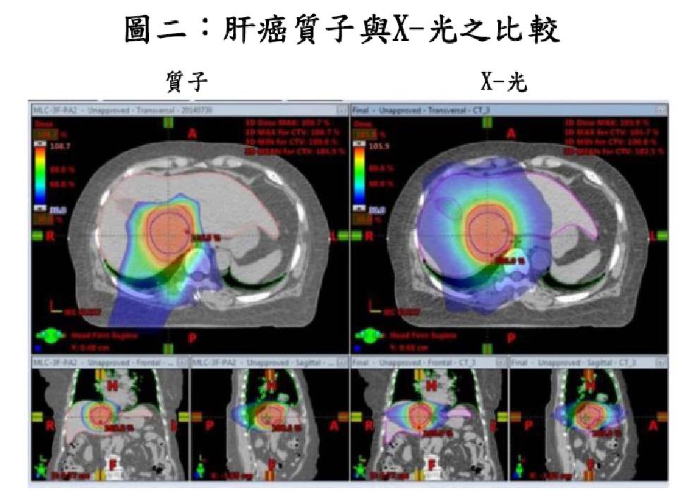 质子治疗