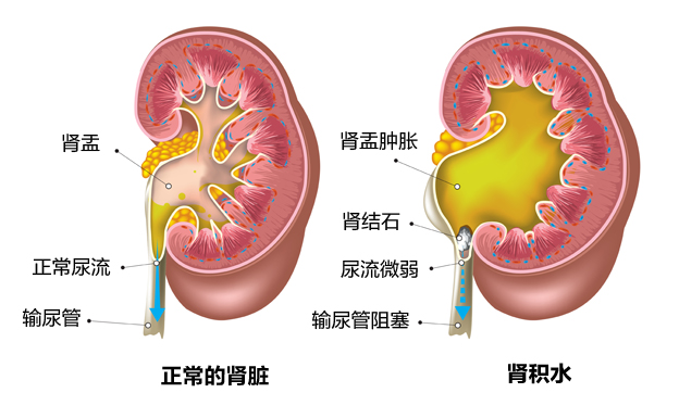 20220924_kidney