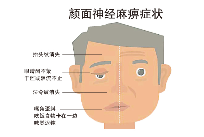 颜面神经麻痹症