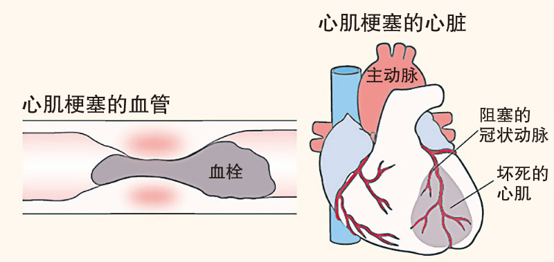 心肌梗塞