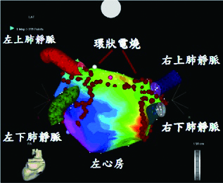 左心房3D立体定位与环状电烧