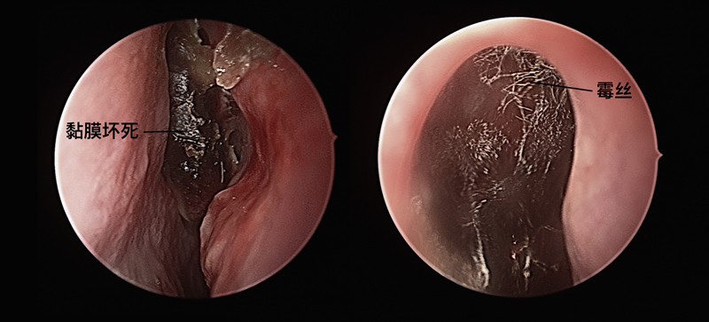 鼻内视镜检查