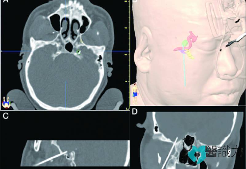 手术中细针可准确置入三叉神经节