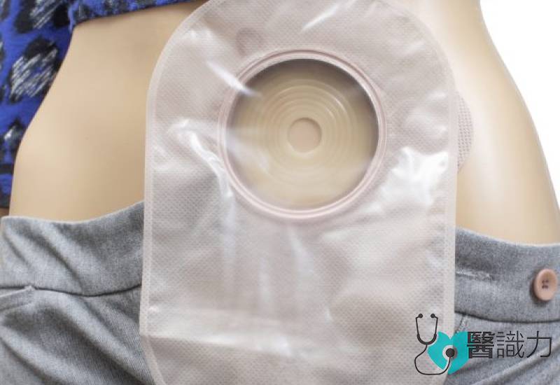 癌症, 肠胃早癌, 腺瘤性息肉, 肿瘤, 内视镜黏膜下剥离术, Endoscopic Submucosal Dissection, ESD, 魏立德,