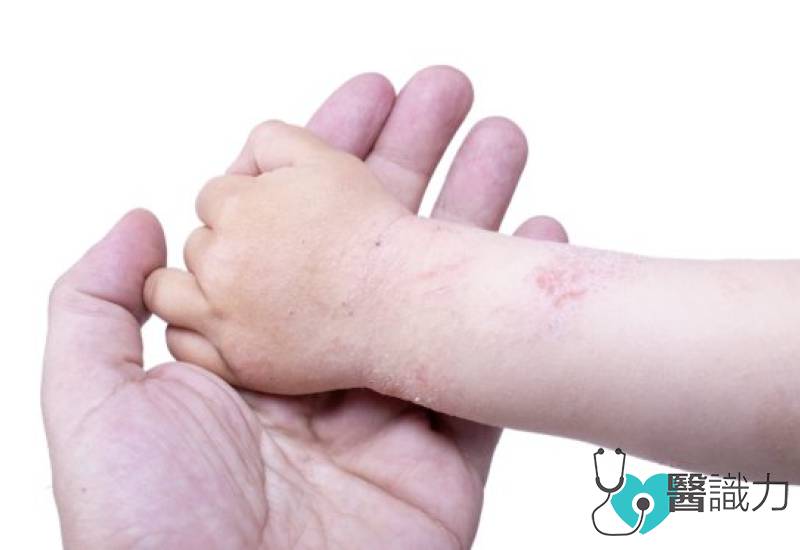 环境太干净反, 疫婴湿疹, 湿疹, 黄秀娟, 肠道菌失衡, 肠道缺双歧杆菌, 抗生素, 益生菌