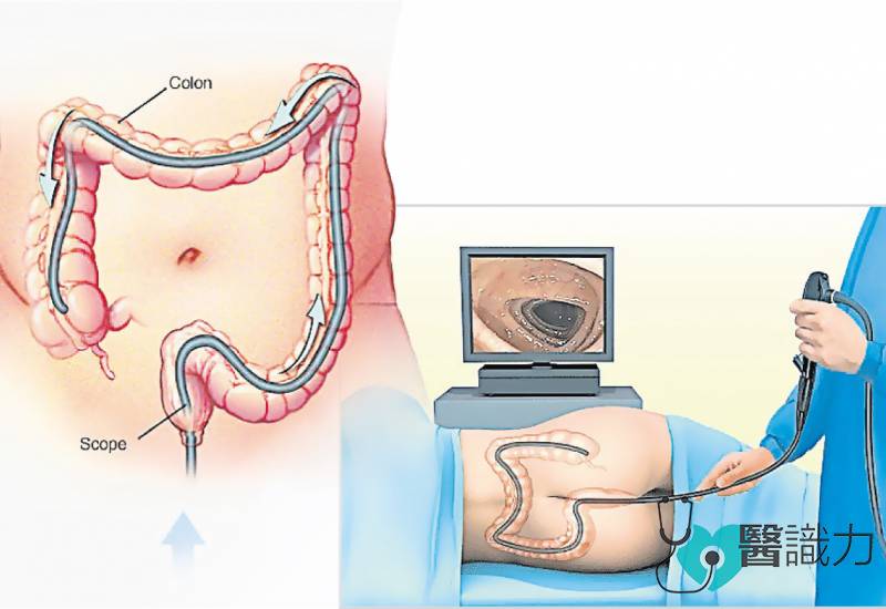 星洲日报，医识力，王庸良，大肠癌，大肠镜