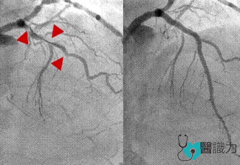 心导管有效治疗冠状动脉阻塞