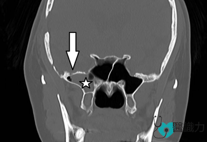 问医, 盛晓峰, 脑水, 鼻窦, 睡觉, 呛,  并发脑膜, 炎maxillary sinus, 脑水渗漏, VP shunt, 腹腔分流手术